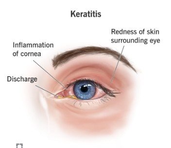 Best Bacterial Keratitis Treatment in Sector 51, Gurugram