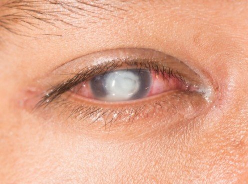 best corneal ulcer treatment in Sector 51, Gurugram