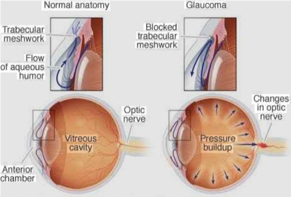 Best Glaucoma Treatment in Sector 51, Gurugram
