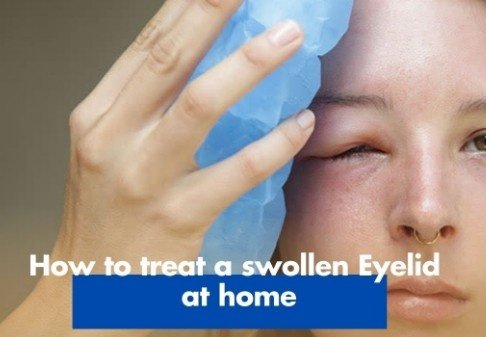 Eyelid Swelling Treatment in Sector 50, Gurugram