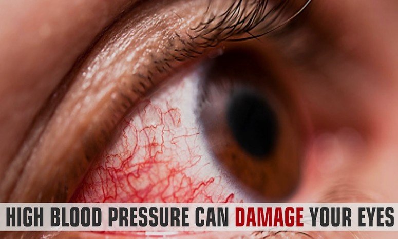 Eye Complications of Hypertension Treatment in Gurugram