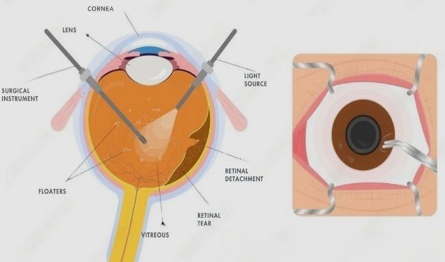 Best Treatment for Eye Floaters in Sector 51, Gurugram